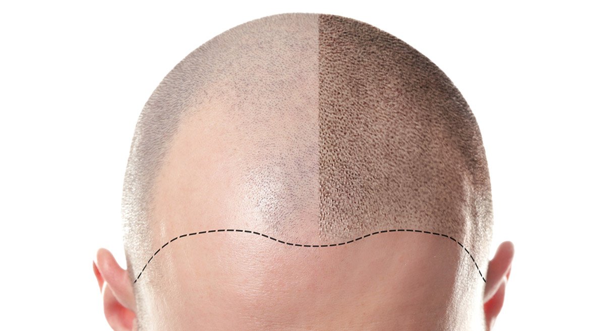 alopecia-tricopigmentazione